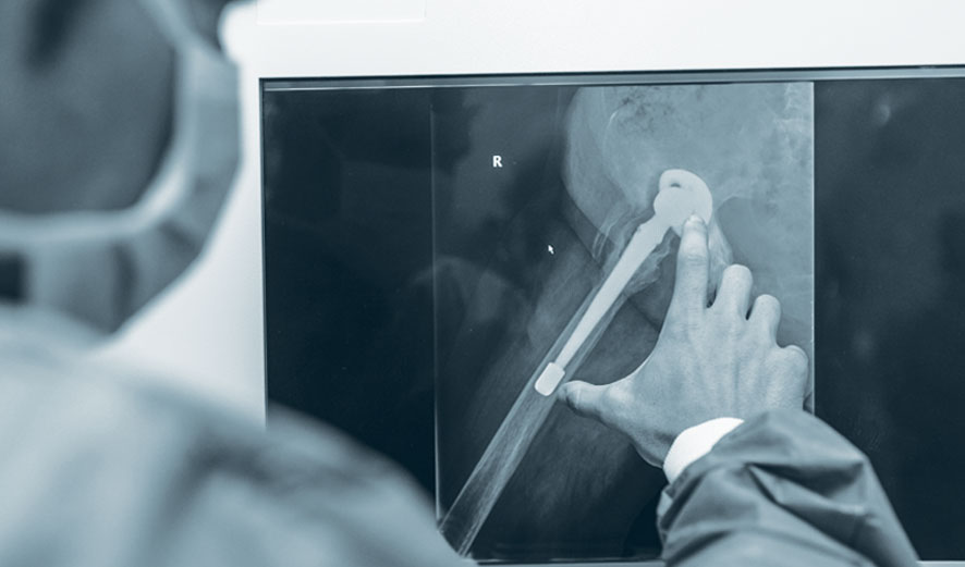 An orthopaedic surgeon analyzing an x-ray of an arthroplasty.
